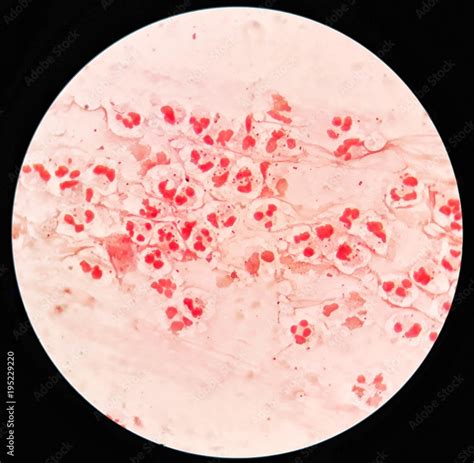Smear Of Sputum Specimen With Gram Negative Cocci Bacteria And Many