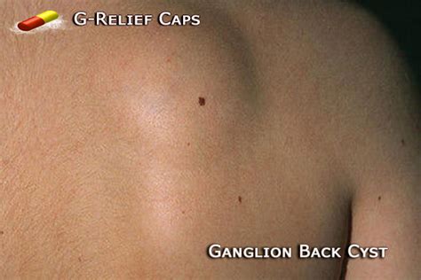 Ganglion Cyst In Neck