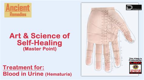 Blood in the urine which is also known as hematuria is not always a problem for concern. Ancient Remedies: Treatment for Blood in Urine (Hematuria ...