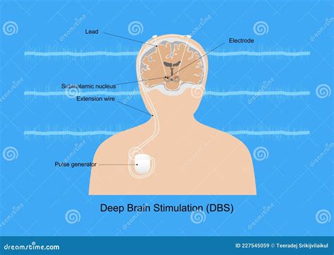 Deep Brain Stimulation For Treatment Of Parkinson Disease Stock Vector