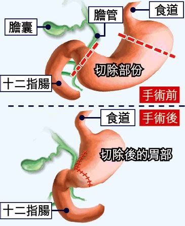Achlorhydria 胃酸缺乏症 digestive system 消化系統 dumping syndrome 胃切除後産生的腹瀉. 抗癌之道 : 癌病人手術後復元篇 ---胃癌＠有緣居士｜PChome 個人新聞台