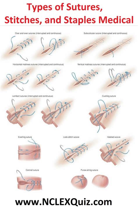 Types Of Sutures Stitches And Staples Medical Wound Care Suturing