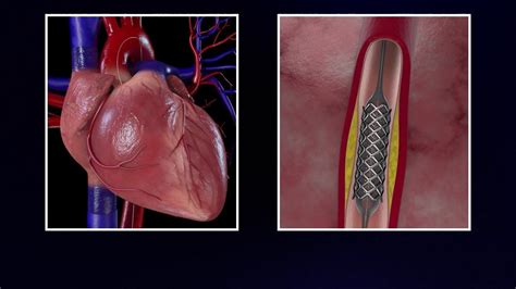 Cardiac Catheterization And Stenting Cardiac Rn Cardiac Sonography