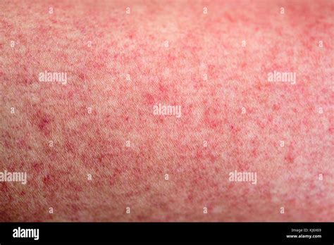 Close Up Human Skin With Dengue Fever Red Rashes Stock Photo Alamy