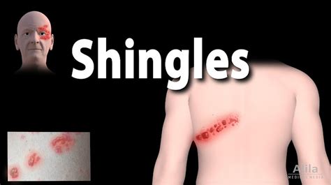 shingles herpes zoster pathophysiology risk factors phases of infection symptoms