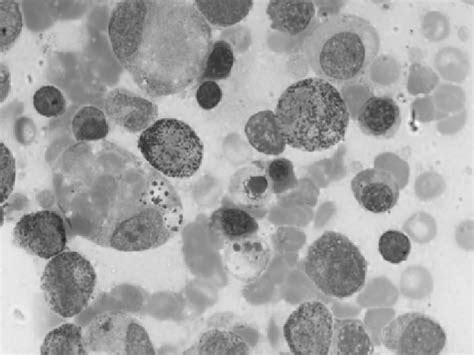 Bone Marrow Smear Showing Histiocytes With Hemopha Gocytosis