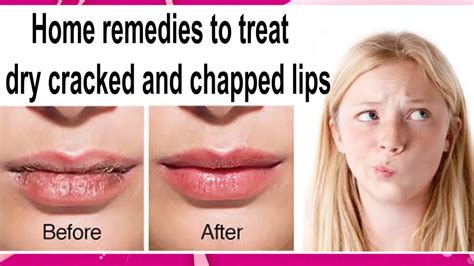 Home Remedies To Treat Dry Cracked And Chapped Lips Youtube