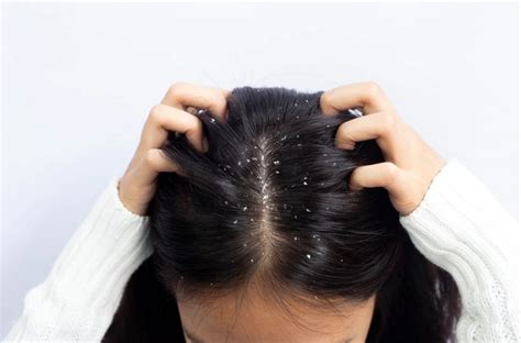 Best Dandruff Treatment That Will Cure Your Inner Health Of Hair