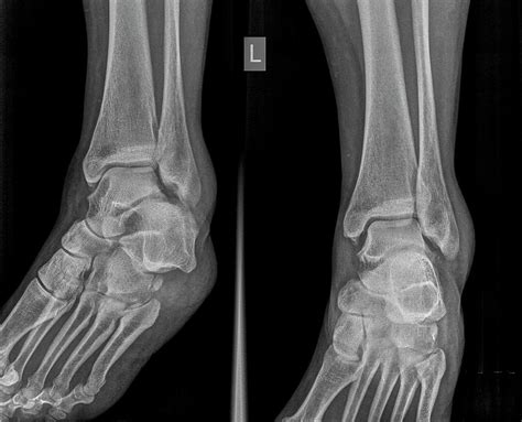 Another view that is commonly done in addition to these views is lateral view. Ankle X-ray Photograph by Photostock-israel