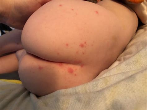 Ringworm Pictures What A Ringworm Rash Looks Like My Xxx Hot Girl