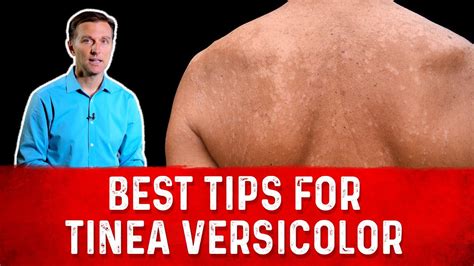 Best Tips For Tinea Versicolor Treatment Skin Fungus Dr Berg Youtube