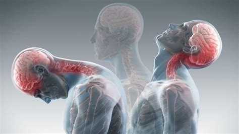 10 Common Signs Of Whiplash Advanced Back And Neck Pain Center Chiropractic