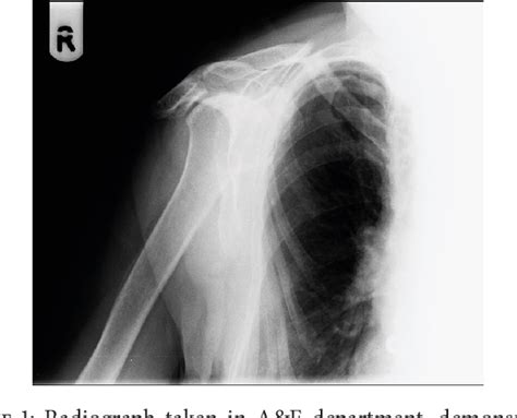 Figure 1 From Acute Nontraumatic Clavicle Fracture Associated With Long