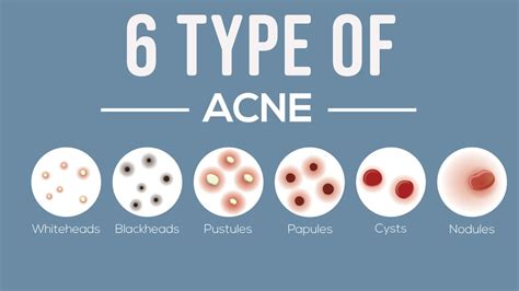 6 Type Of Acne How To Treat Them Youtube