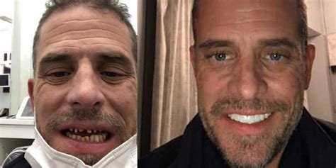 New York Post Hunter Biden Photos Claim To Show Before And After Dental