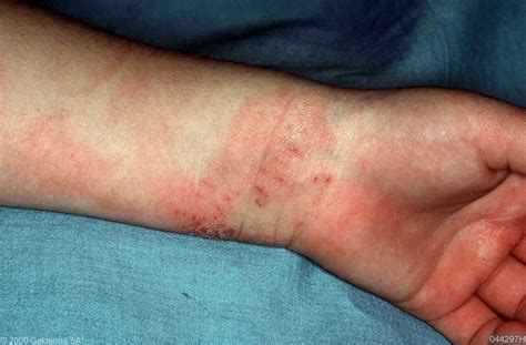 Eczema Elbow Pictures Photos