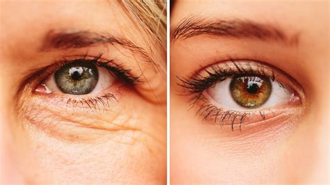 Natural Remedy For Sagging Eyelids You Will See Results In 2 Minutes