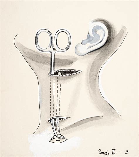 Illustrations Series Ii3 Removal Of A Second Branchial Cleft