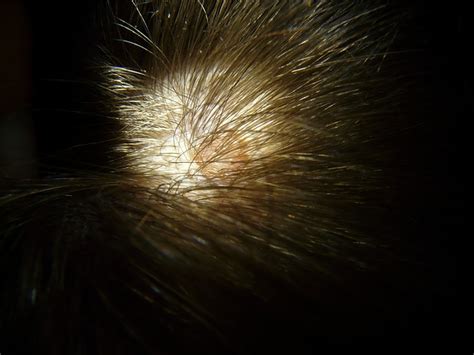Bumps On Scalp What Are They And Why I Have It Wound Care Society