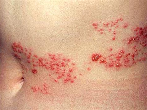 Is It Shingles 7 Myths About Painful Illness Graphic Images Photo