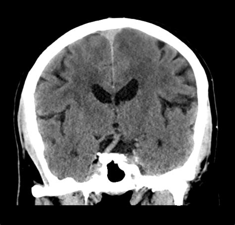Left Cerebellar Infarct PICA Vascular Territory Image Radiopaedia Org