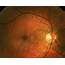 Optic Neuritis  Pictures Symptoms Causes Diagnosis Treatment