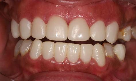 Cosmetic Dentistry Procedures Smile Gallery Humble Dentist