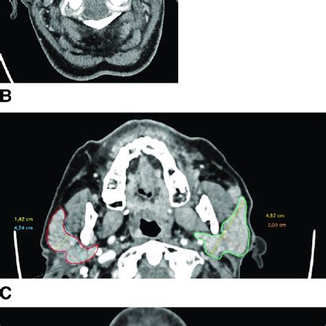 Ct Of The Head Showing Bilaterally Enlarged Parotid Glands A Overview