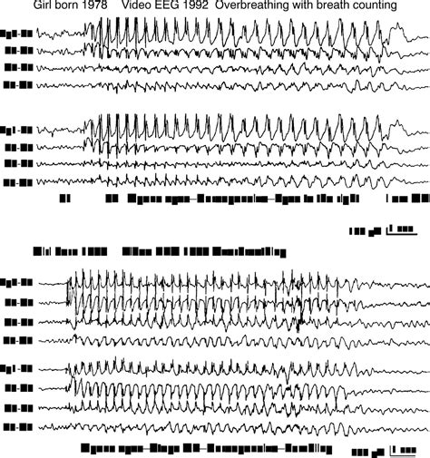 Typical Absence Seizures And Their Treatment Archives Of Disease In