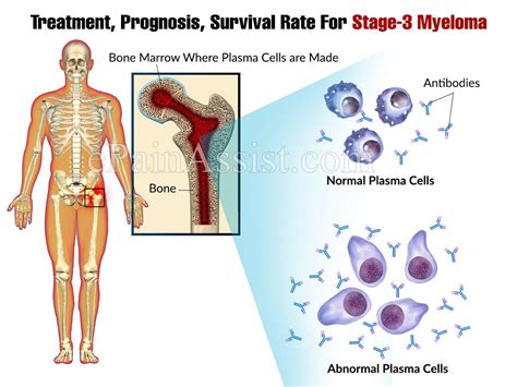 Treatment Prognosis Survival Rate For Stage 3 Myeloma
