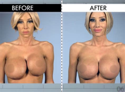 Pornstars With Fake Tits Before After Breast Augmentation