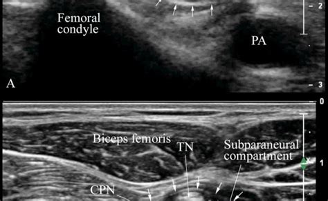 Ultrasound Guided Popliteal Sciatic Nerve Block Otosection