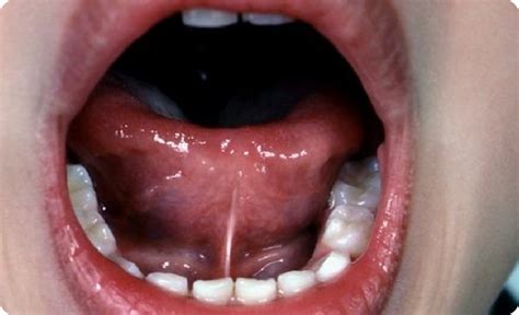 Tongue Tie Symptoms Weybridge Myokids Dental