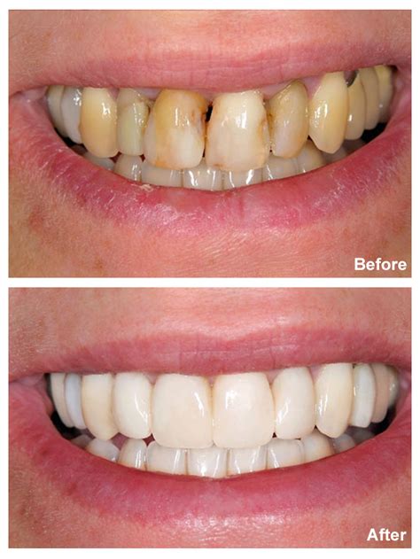 We did not find results for: Are Veneers Bad For Your Teeth? - Sedation and Implant ...
