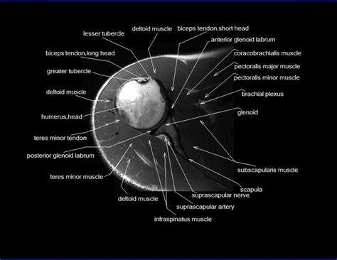 Basic physics & a brief history. shoulder anatomy | mri shoulder axial anatomy | free cross ...