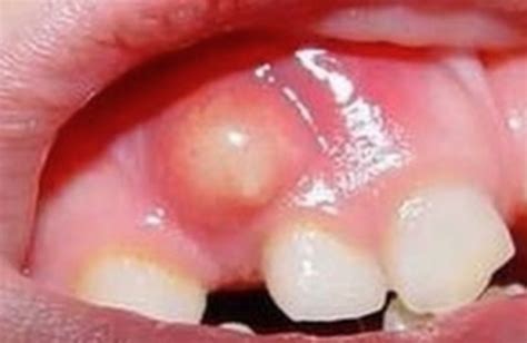What Is Oral Cyst French Dental Services Drmiski Dubai