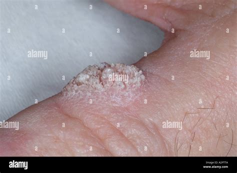 Viral Wart Stock Photo Alamy