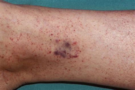 Petechiae Pictures Causes Symptoms Diagnosis And Treatment
