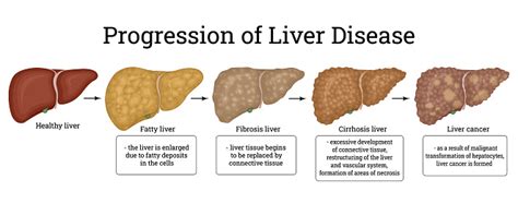 Illustration Of The Stages Of Liver Damage Stock Illustration