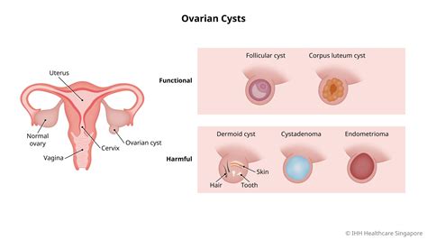 ovarian cysts symptoms and causes parkway east hospital