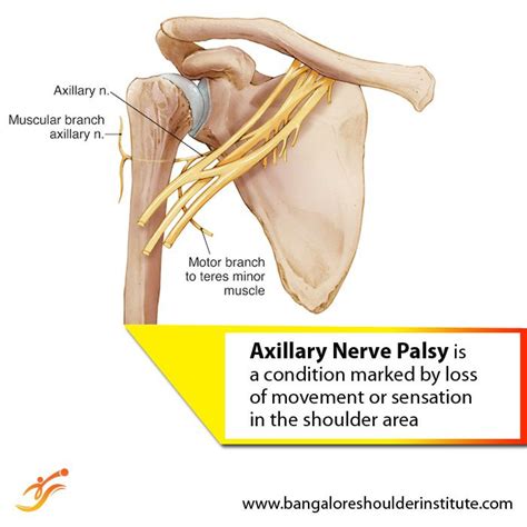 Axillary Nerve Injury Nerve Palsy Shoulder Dislocation Axillary Nerve