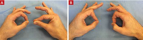 Anterior Interosseous Nerve Syndrome