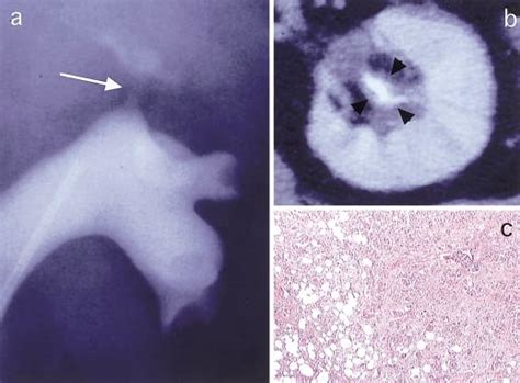 A A Retrograde Pyelogram Showing Upper Infundibular Stenosis Arrow