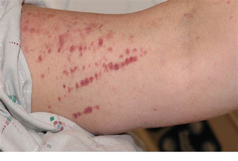 Petechiae In Pregnancy Babycenter