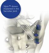 Si Joint Fusion Surgery Recovery Images