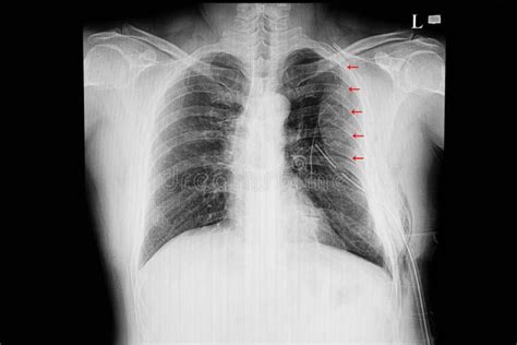 Chest Xray Film Of A Patient With Multiple Rib Fractures Stock Photo