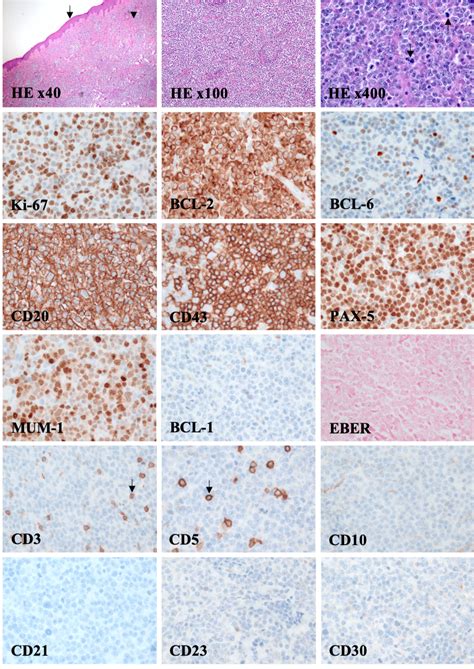 Cureus Primary Cutaneous Diffuse Large B Cell Lymphoma Leg Type A