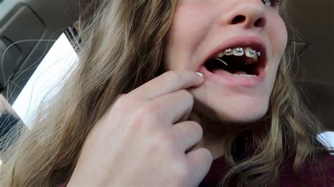 Braces Update Loose Wire Very Painful Youtube