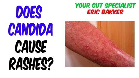 Can A Candida Cleanse Cause A Skin Rash Youtube