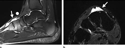 Ganglion Cyst Displacing The Ehl Tendon In A 33 Year Old Woman With A